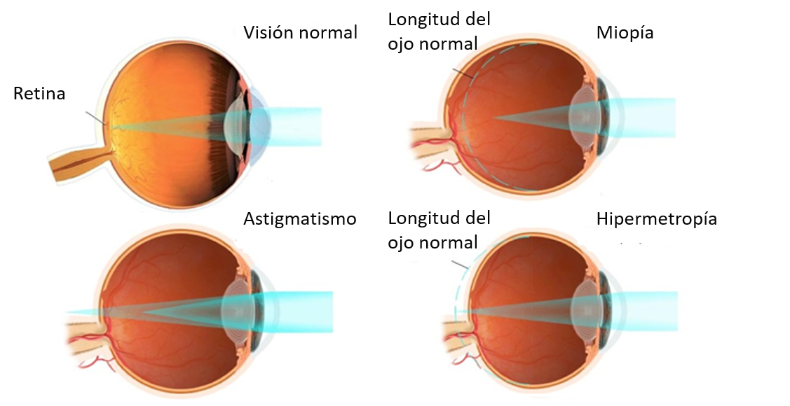 miopia astigmatica e astigmatismo