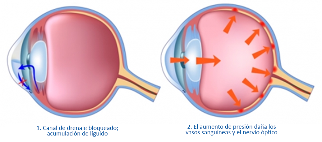 Вернуть зрение при глаукоме. Схема глаза при глаукоме. Здоровый глаз и глаукома.